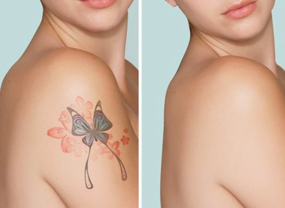 Il costo per togliere un tatuaggio a Bari dipende dalla tecnica che si vuole usare e da quanto sia esteso il tatuaggio.